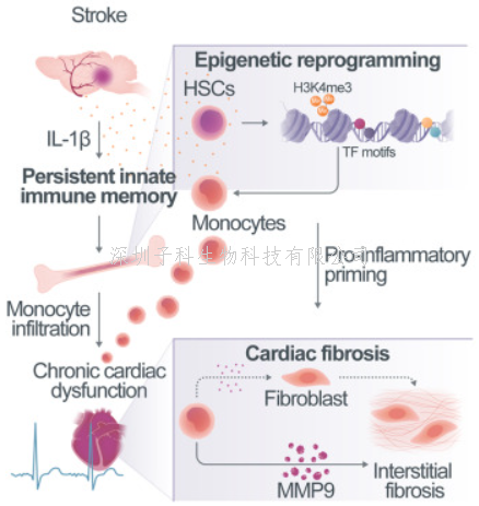 中風(fēng)損傷大腦 還損傷先天免疫記憶 IL-1β引發(fā)慢性合并癥/繼發(fā)性心臟病
